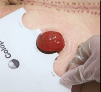 Use measuring tape to determine the size of the stoma and choose an appropriate baseplate accordingly.