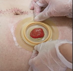 Remove the protective backing from the baseplate and firmly apply it to the skin around the stoma. 