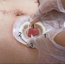 To close the ostomy bag, follow the four-point method: First, securely attach the bottom of the bag's connecting ring to the baseplate (point one). 